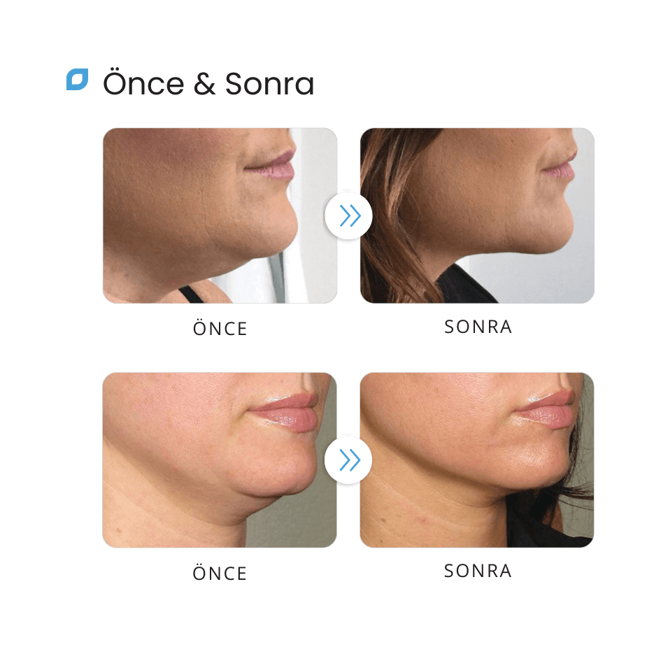 DR. Lipo+ - Yüz Yağ Çözücü Önce - Sonra (1) DR. Lipo+ - Yüz Yağ Çözücü Önce - Sonra (1)